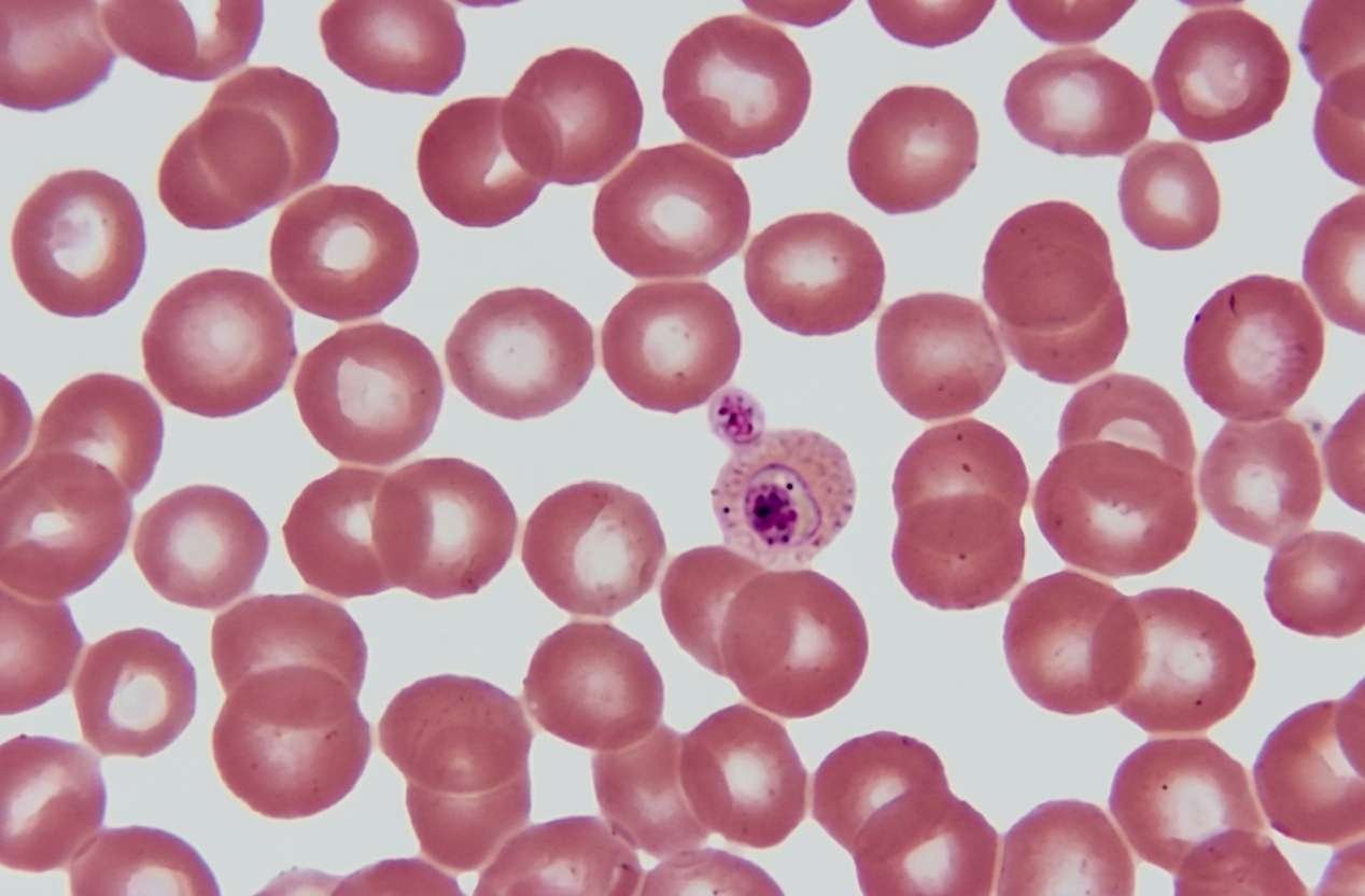 Brightfield blood-smear microscopy field with pink erythrocytes and a purple-stained nucleated cell; source image for this educational visual